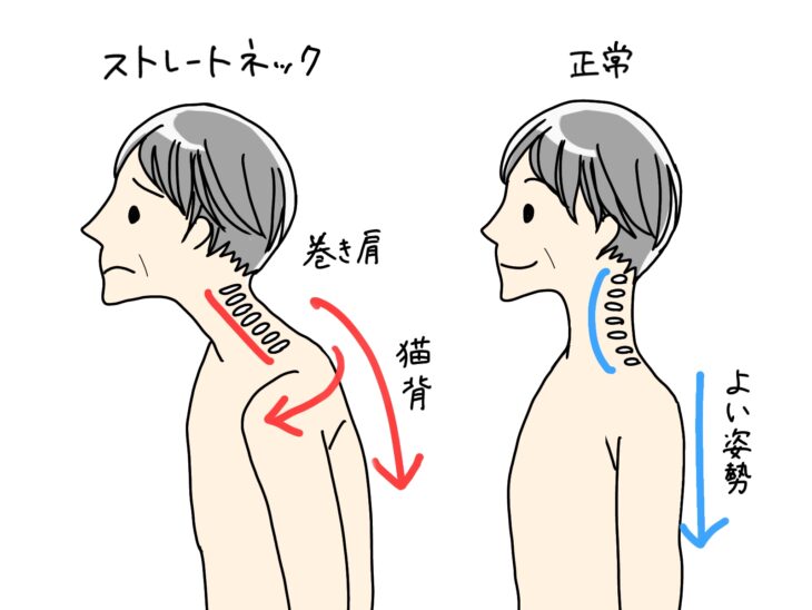 巻き肩とは？/カイロライン多摩・唐木田整体室