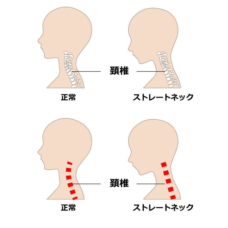 正常な首とスマホ首の違い/カイロライン多摩・唐木田整体室